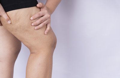 Lipedema ganha visibilidade durante o Junho Roxo e alerta para a importância do diagnóstico