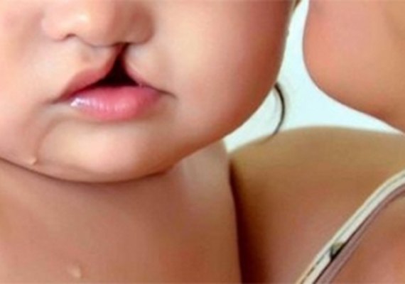 Estado discute metodologia e ampliação de pesquisa sobre fendas orais