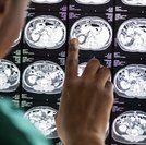 Neurocirurgião alerta para sinais de hemorragia cerebral e reforça importância do atendimento rápido