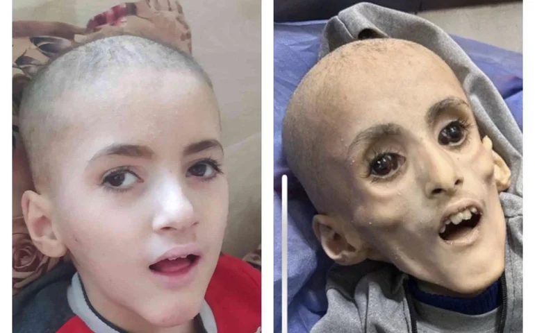 Yazan Kafarneh: o menino de 10 anos que se tornou o rosto da fome em Gaza