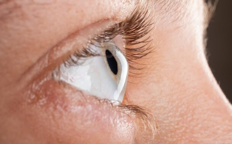 Novas técnicas regularizam a curvatura da córnea com ceratocone