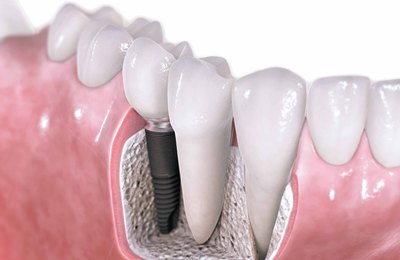Tudo o que você precisa saber sobre a manutenção de um implante dentário