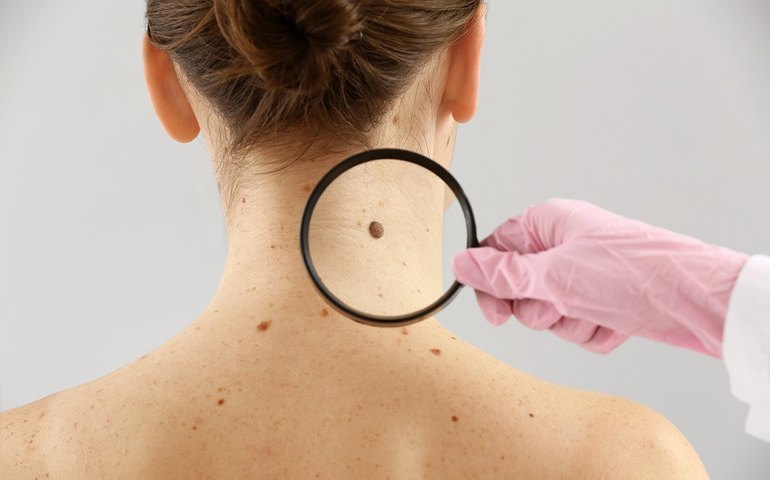 Entenda por que algumas pessoas têm diferentes tipos de câncer ao longo da vida