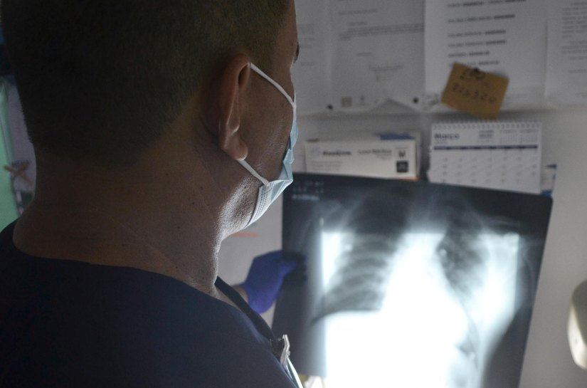 Tuberculose leva a óbito 25 pessoas em Alagoas no ano passado