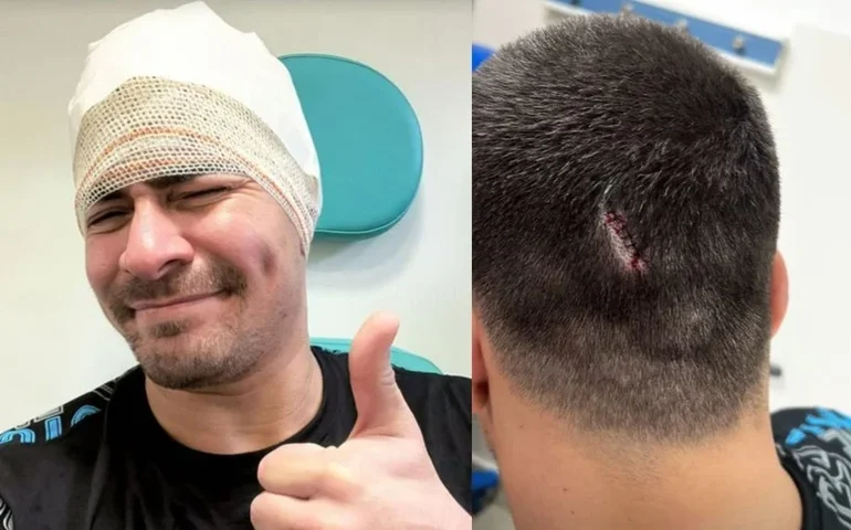 Thiago Martins sofre acidente no set da série de 'Cidade de Deus' e leva seis pontos