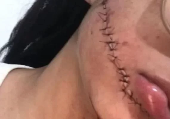 Jovem tem rosto esfaqueado em ônibus