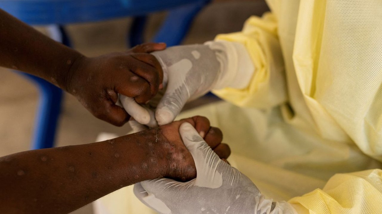África declara emergência em saúde pública por epidemia de mpox