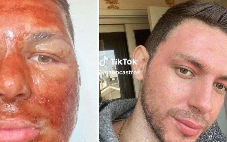 'Peeling de fenol': homem de 27 anos morre após fazer procedimento estético