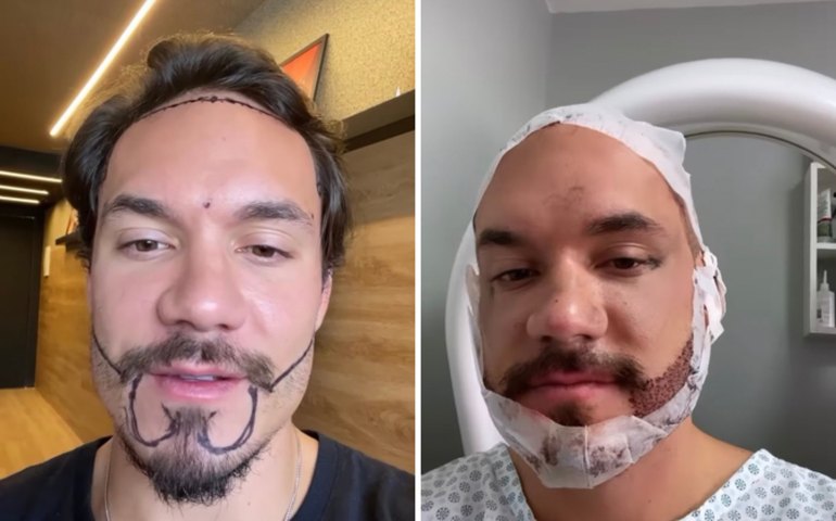 Ex-BBB Eliezer realiza transplante de cabelo e barba para &#8216;corrigir falhas&#8217;