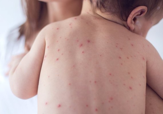 Estudante de escola pública em Maceió é diagnosticada com meningite bacteriana