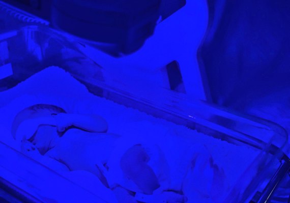 Pediatra reforça importância da fototerapia para tratamento de icterícia em recém-nascidos