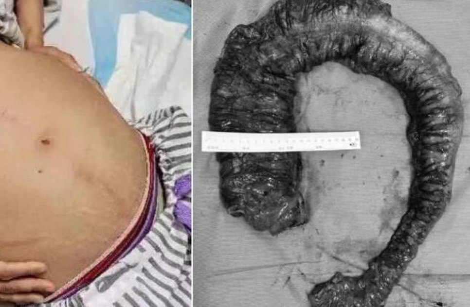 Médicos retiram 20 kg de fezes 'semelhante a píton' do intestino de mulher