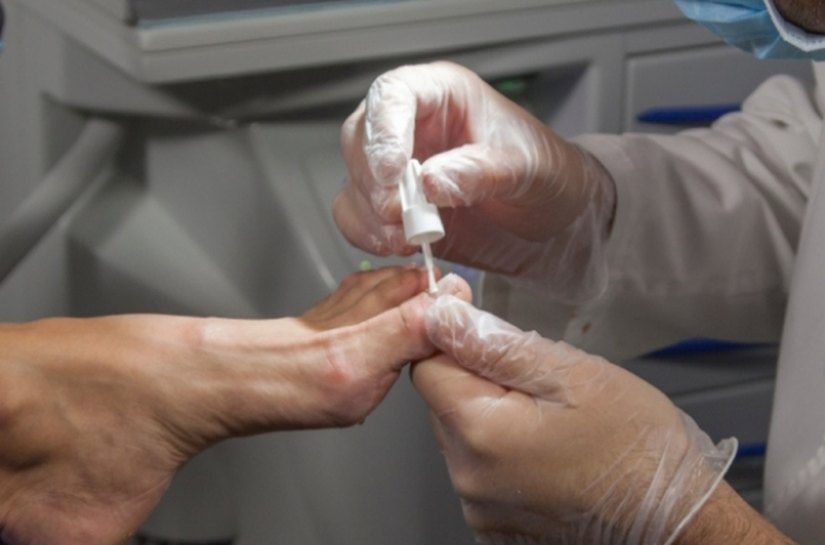 Dermatologista orienta sobre como tratar e evitar fungos nas unhas