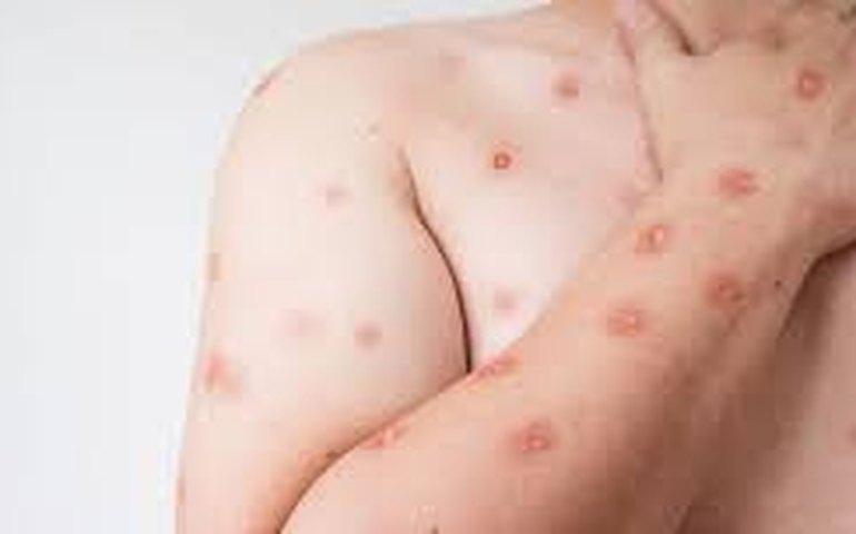 Mpox: Congo registra mais de 18 mil casos e 615 mortes em 2024