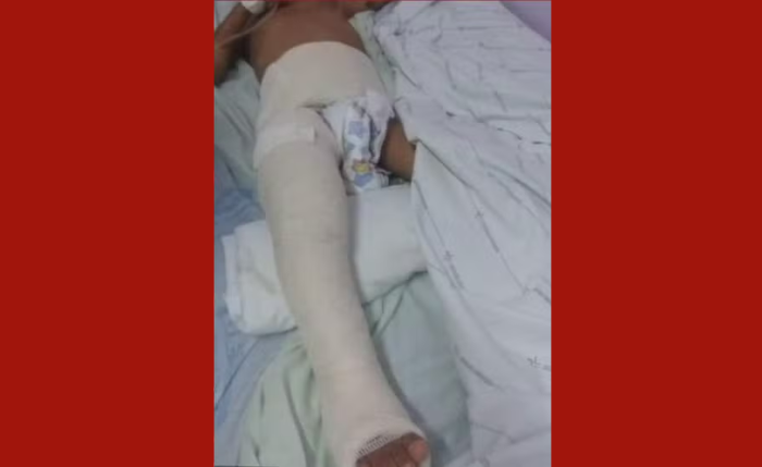 Criança de 4 anos tem perna e quadril imobilizados após espancamento