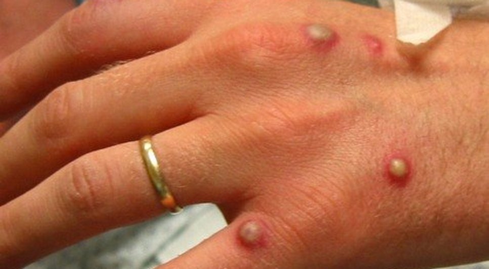 variola-macaco-monkeypox-20052022150612452