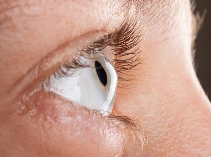 Fatores de risco para o Ceratocone, entre eles coçar os olhos
