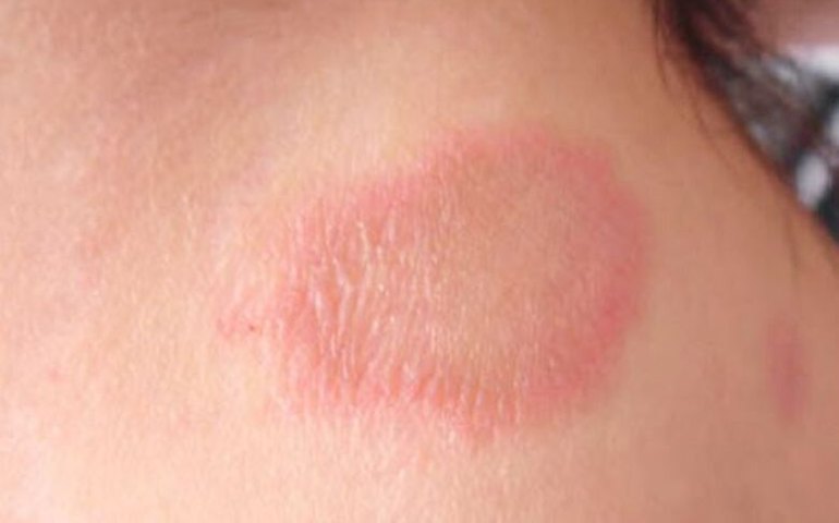 Janeiro Roxo: Prefeitura lança campanha de combate à Hanseníase