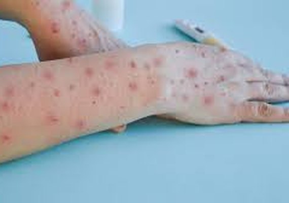 Secretaria de Estado da Saúde segue monitorando situação da Monkeypox em Alagoas