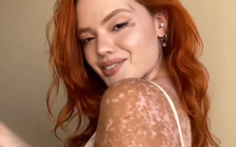 Vitiligo: influencer com a mesma doença de Michael Jackson, conta por que não se considera branca; entenda