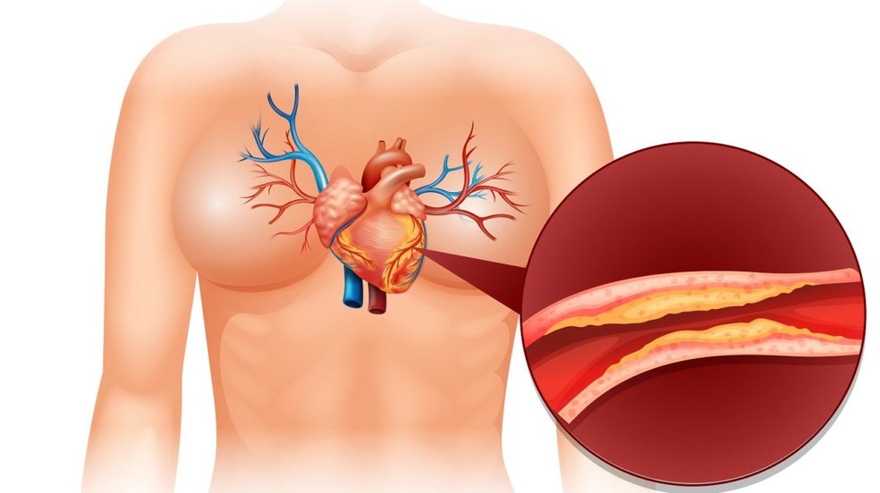 Colesterol alto afeta 40% dos brasileiros