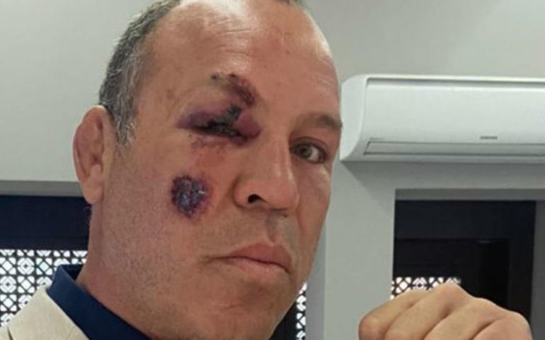 De bicicleta, Wanderlei Silva é atropelado em Curitiba e sofre fratura no pé