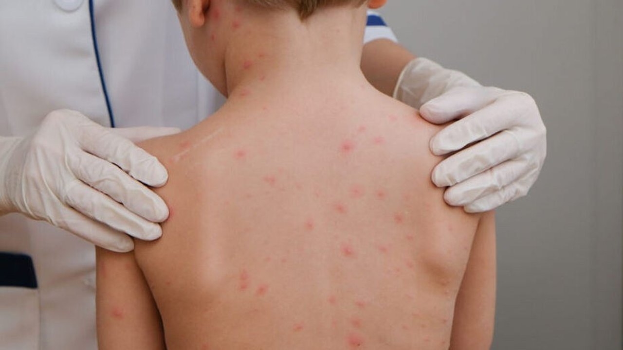 Mato Grosso registra 29 casos e 8 mortes por meningite em 2026; Saúde descarta surto