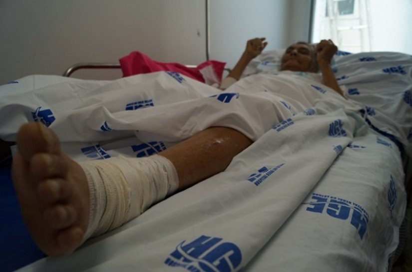 Varizes são indícios de problemas vasculares, alerta médico do HGE