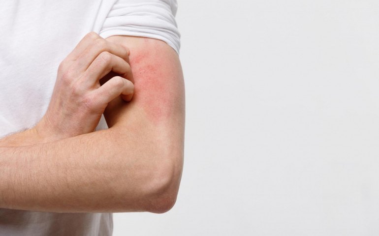 Dia Mundial Contra a Hanseníase: Saúde reforça importância do diagnóstico precoce contra a doença