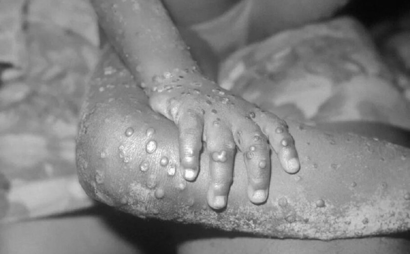 Rio de Janeiro tem primeiro caso registrado de varíola dos macacos