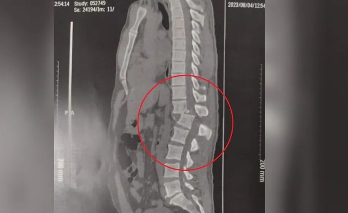 Tomografia mostra lesão na coluna de jovem atingido por aparelho em academia de ginástica no Ceará