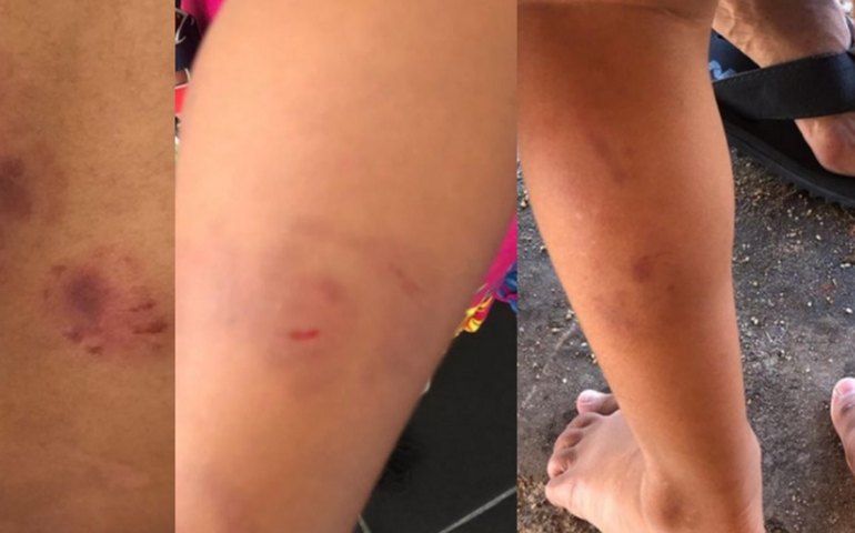 Duas professoras são indiciadas depois que uma criança levou 19 mordidas em creche em Coruripe