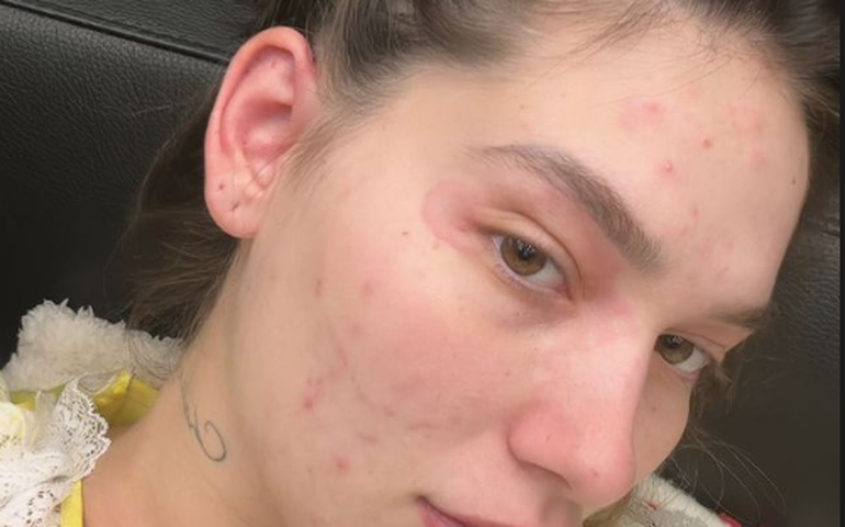 Farmacodermia: entenda a reação alérgica vivida por Virginia Fonseca