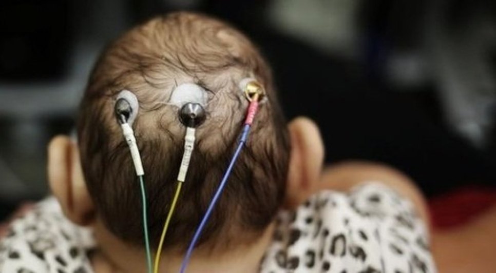 BEBE COM MICROCEFALIA 