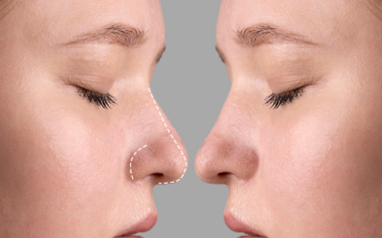 Rinoplastia: estética ou saúde? Entenda quando a cirurgia do nariz é necessária