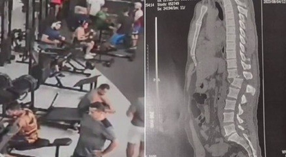 Aluno atingido por aparelho de musculação em academia tem 1% de chance de voltar a andar