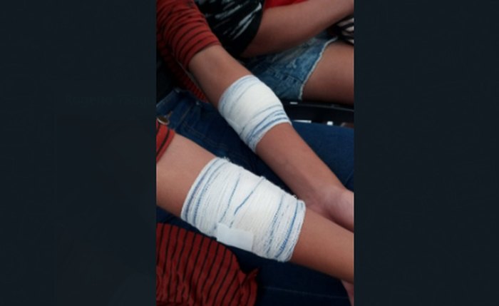 Aluna com curativo nos braços feridos com o estilete de outra estudante
