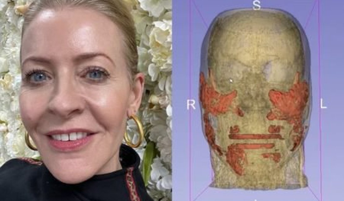 Mulher faz ressonância e descobre ácido hialurônico de 4 anos no rosto