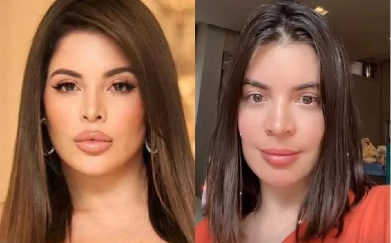 Gkay divulga fotos após retirar preenchimento dos lábios