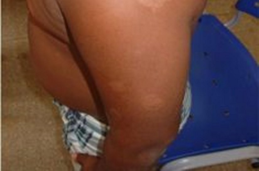 Campanha contra Hanseníase e Verminose será aberta dia 25