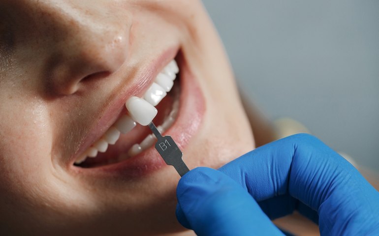 Aplicação de facetas dentárias exigem técnica especializado