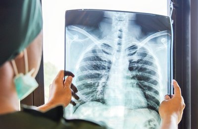 Tomografias revelam aumento de complicações por Covid em Penedo