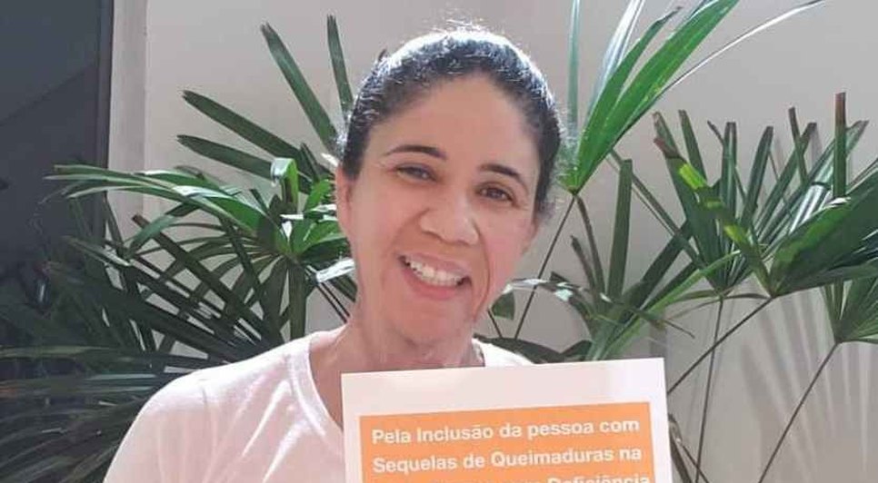 QUEIMADURA / Foto: Assessoria CHANGE.ORG Brasil
