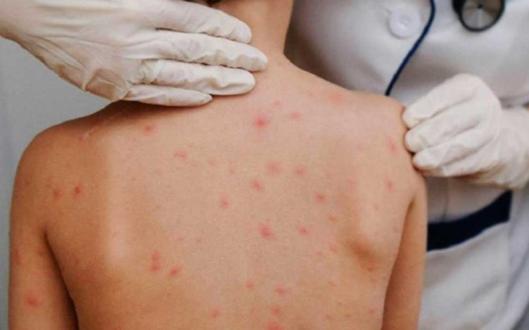 Surto de sarna afeta escolas em Balneário Camboriú; saiba como se proteger