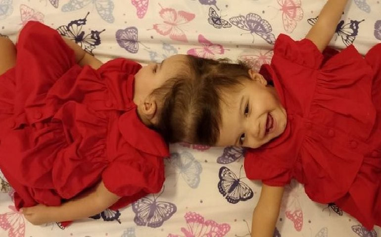 'É como  se um cérebro invadisse o outro', diz médico de cirurgia de separação de gêmeas  siamesas em Ribeirão Preto