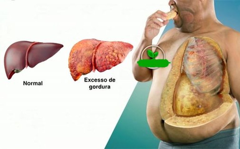 Gordura no fígado: como prevenir a doença que afeta um quarto da população