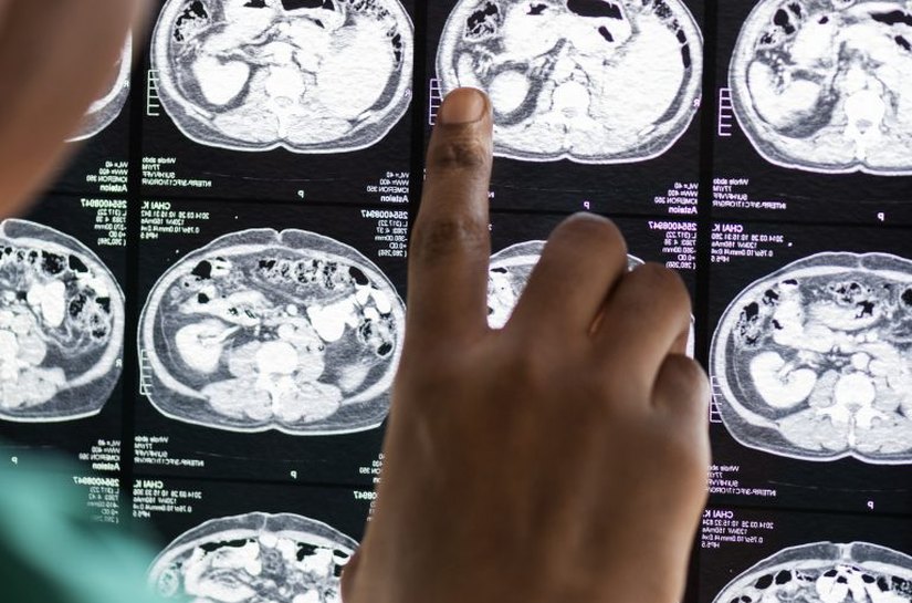 Neurocirurgião alerta para sinais de hemorragia cerebral e reforça importância do atendimento rápido