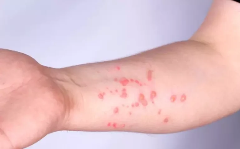 'Temos produção e estoque de doses', diz representante de única farmacêutica que produz vacina de mpox 