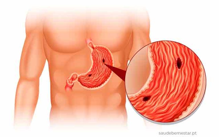 Úlcera: o que é, causas, sintomas e tratamento