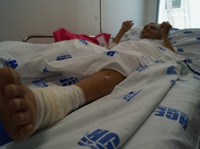 Varizes são indícios de problemas vasculares, alerta médico do HGE